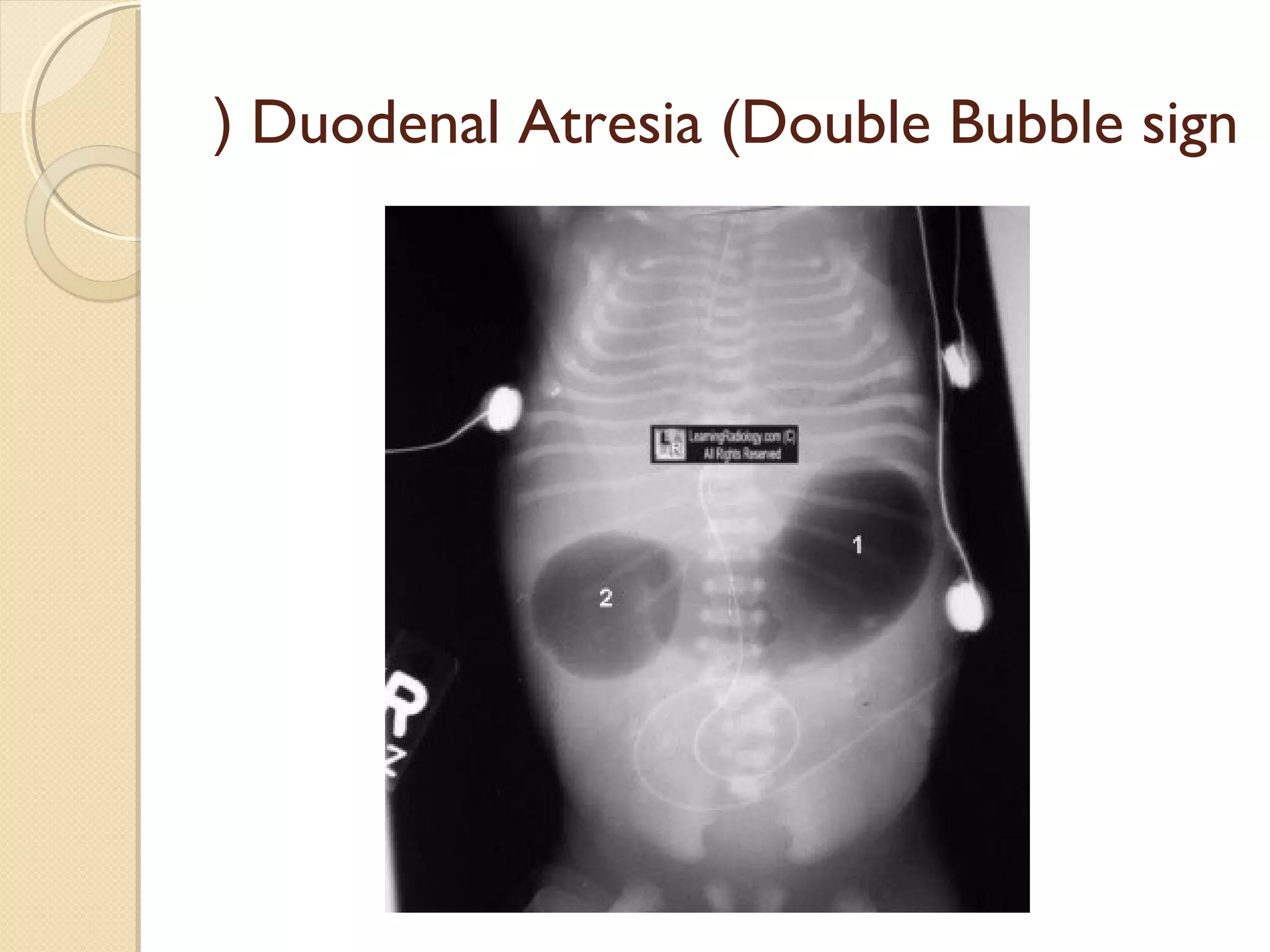 Duodenal Atresia (Double Bubble sign(
 