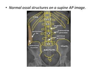 • Normal ossal structures on a supine AP image.
 