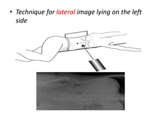 • Technique for lateral image lying on the left
side
 
