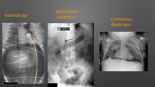 Football sign
Football sign
FALCIFORM
LIGAMENT Continuous
diaphragm
 