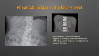 Pneumobilia (gas in the biliary tree)
Pneumobilia is gas in the biliary tree.
Appears as branching dark lines in the centre
of the liver, usually larger and more prominent
towards the hilum
 