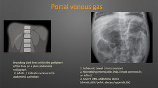 Portal venous gas
Branching dark lines within the periphery
of the liver on a plain abdominal
radiograph.
In adults, it indicates serious intra‐
abdominal pathology
1. Ischaemic bowel (most common)
2. Necrotising enterocolitis (NEC) (most common in
an infant)
3. Severe intra abdominal sepsis
‐
(diverticulitis/pelvic abscess/appendicitis)
 