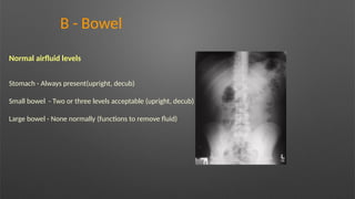 B - Bowel
Normal airfluid levels
Stomach - Always present(upright, decub)
Small bowel - Two or three levels acceptable (upright, decub)
Large bowel - None normally (functions to remove fluid)
 