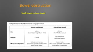 Bowel obstruction
Small bowel vs large bowel
 
