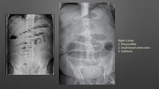 Rigler’s triad:
1. Pneumobilia
2. Small bowel obstruction
3. Gallstone
 
