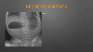 5.DOUBLE BUBBLE SIGN
Findings -Dilatation of the proximal duodenum and stomach
Causes :
– Duodenal atresia
 