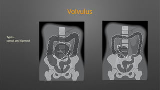 Volvulus
Types-
caecal and Sigmoid
 