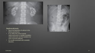 12/03/2024 27
Nephrocalcinosis
• Abnormal deposition of calcium in the
kidney parenchyma.
• It can affect the cortex (cortical
nephrocalcinosis) or medulla (medullary
nephrocalcinosis), but the medulla is far
more commonly affected.
• It is usually associated with metabolic
disorders.
 