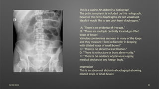 12/03/2024 32
This is a supine AP abdominal radiograph
The pubic symphysis is included on this radiograph,
however the hemi diaphragms are not visualised.
‐
Ideally I would like to see both hemi diaphragms.”
‐
A: “There is no evidence of free gas.”
B: “There are multiple centrally located gas filled
‐
loops of bowel
Valvulae conniventes are seen in many of the loops
and they measure >3cm in diameter in keeping
with dilated loops of small bowel.”
C: “There is no abnormal calcification.”
D: “There is no fracture or bony abnormality.”
E: “There is no evidence of previous surgery,
medical devices or any foreign body.”
Impression
This is an abnormal abdominal radiograph showing
dilated loops of small bowel.
 