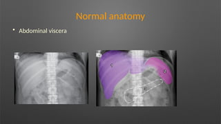 Normal anatomy
• Abdominal viscera
 