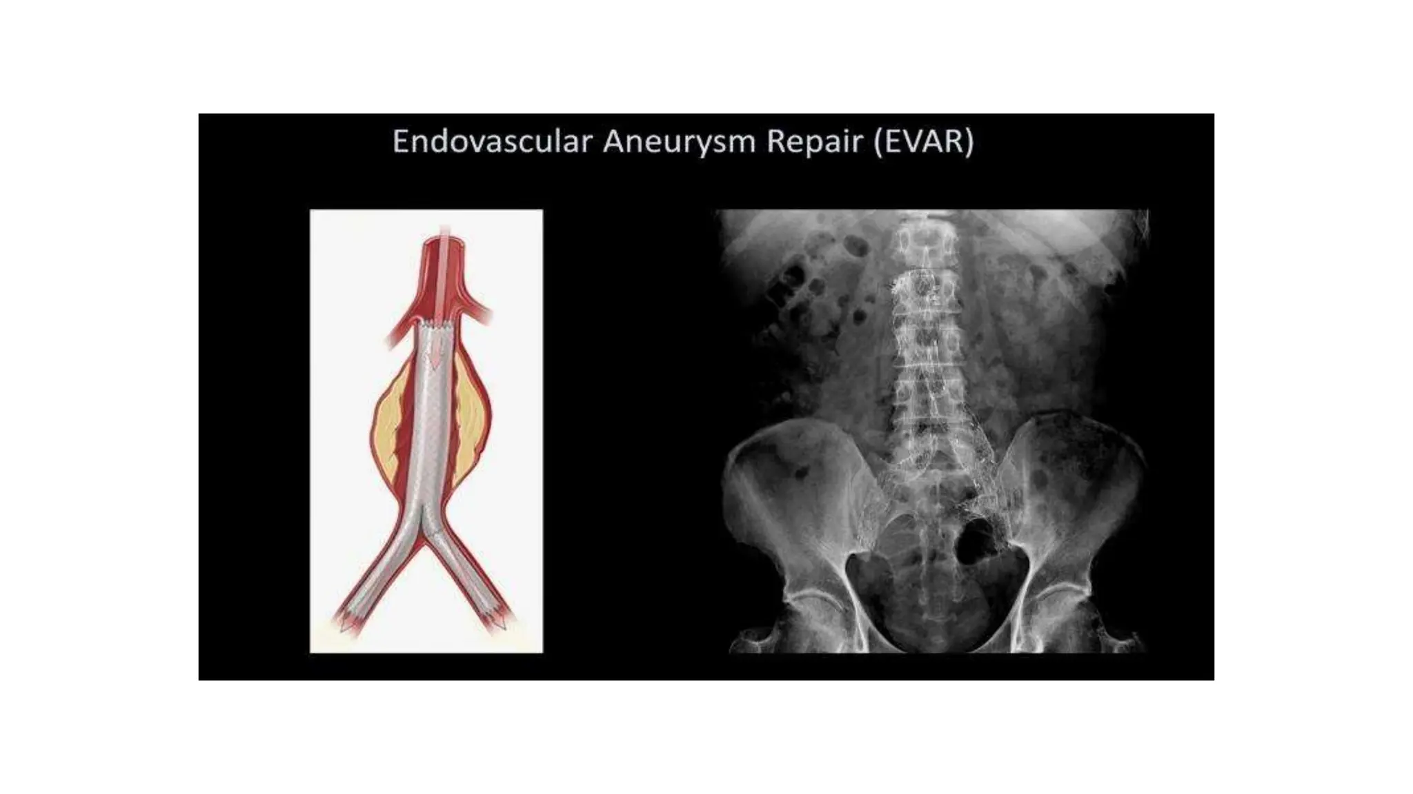 Abdominal Xray Interpretation For Surgery And 