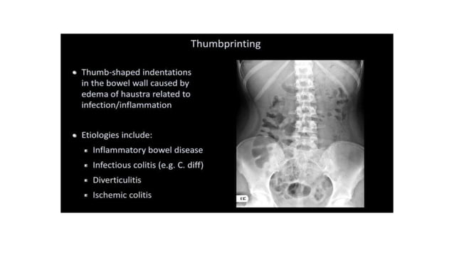 Abdominal Xray Interpretation For Surgery And 