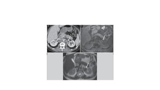 Abdominl Tuberculosis imaging features.pptx