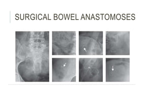 SURGICAL BOWEL ANASTOMOSES
 