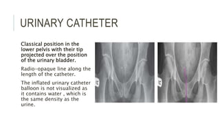 URINARY CATHETER
Classical position in the
lower pelvis with their tip
projected over the position
of the urinary bladder.
Radio-opaque line along the
length of the catheter.
The inflated urinary catheter
balloon is not visualized as
it contains water , which is
the same density as the
urine.
 