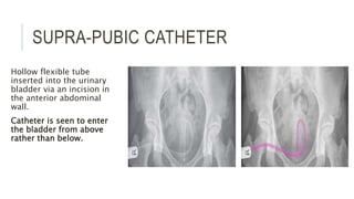SUPRA-PUBIC CATHETER
Hollow flexible tube
inserted into the urinary
bladder via an incision in
the anterior abdominal
wall.
Catheter is seen to enter
the bladder from above
rather than below.
 