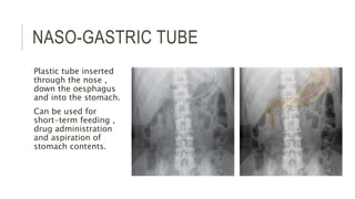 NASO-GASTRIC TUBE
Plastic tube inserted
through the nose ,
down the oesphagus
and into the stomach.
Can be used for
short-term feeding ,
drug administration
and aspiration of
stomach contents.
 