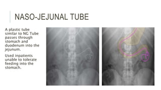 NASO-JEJUNAL TUBE
A plastic tube
similar to NG Tube
passes through
stomach and
duodenum into the
jejunum.
Used inpatients
unable to tolerate
feeding into the
stomach.
 