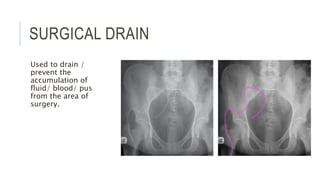 SURGICAL DRAIN
Used to drain /
prevent the
accumulation of
fluid/ blood/ pus
from the area of
surgery.
 