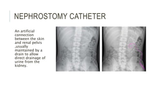 NEPHROSTOMY CATHETER
An artificial
connection
between the skin
and renal pelvis
,usually
maintained by a
drain to allow
direct drainage of
urine from the
kidney.
 