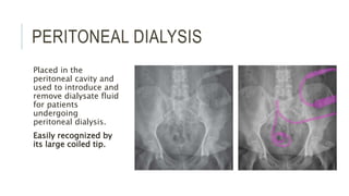 PERITONEAL DIALYSIS
Placed in the
peritoneal cavity and
used to introduce and
remove dialysate fluid
for patients
undergoing
peritoneal dialysis.
Easily recognized by
its large coiled tip.
 