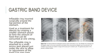 GASTRIC BAND DEVICE
Inflatable ring inserted
surgically around the
top portion of the
stomach.
Used as a treatment for
obesity by creating a
smaller stomach pouch
to limit the amount of
food that can be
consumed at one sitting.
The inflatable ring is
attached to a small
access port placed just
under the skin to allow
re-adjustment of the
 