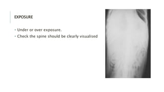 EXPOSURE
 Under or over exposure.
 Check the spine should be clearly visualised
 