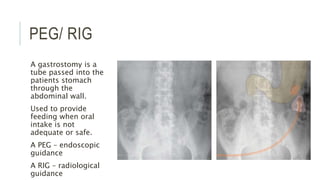 PEG/ RIG
A gastrostomy is a
tube passed into the
patients stomach
through the
abdominal wall.
Used to provide
feeding when oral
intake is not
adequate or safe.
A PEG – endoscopic
guidance
A RIG – radiological
guidance
 