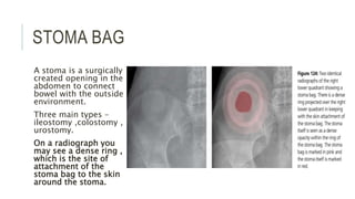 STOMA BAG
A stoma is a surgically
created opening in the
abdomen to connect
bowel with the outside
environment.
Three main types –
ileostomy ,colostomy ,
urostomy.
On a radiograph you
may see a dense ring ,
which is the site of
attachment of the
stoma bag to the skin
around the stoma.
 