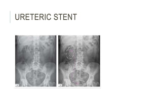 URETERIC STENT
 