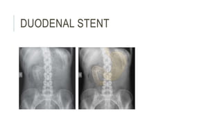 DUODENAL STENT
 