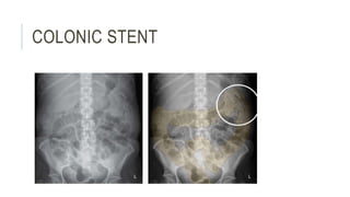 COLONIC STENT
 