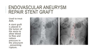 ENDOVASCULAR ANEURYSM
REPAIR STENT GRAFT
Used to treat
AAA.
A stent graft
is placed in
the lumen of
the aorta to
allow blood
to flow and
reduce
pressure in
the aneurysm
, preventing
rupture.
 