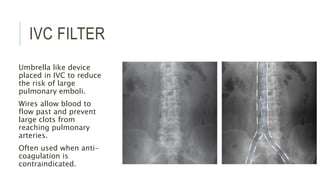 IVC FILTER
Umbrella like device
placed in IVC to reduce
the risk of large
pulmonary emboli.
Wires allow blood to
flow past and prevent
large clots from
reaching pulmonary
arteries.
Often used when anti-
coagulation is
contraindicated.
 