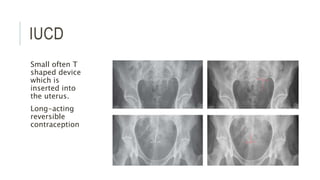 IUCD
Small often T
shaped device
which is
inserted into
the uterus.
Long-acting
reversible
contraception
 