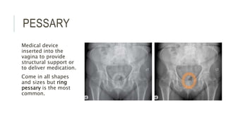 PESSARY
Medical device
inserted into the
vagina to provide
structural support or
to deliver medication.
Come in all shapes
and sizes but ring
pessary is the most
common.
 