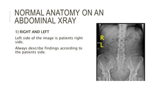 NORMAL ANATOMY ON AN
ABDOMINAL XRAY
1) RIGHT AND LEFT
Left side of the image is patients right
side.
Always describe findings according to
the patients side.
R
L
 
