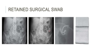 RETAINED SURGICAL SWAB
 