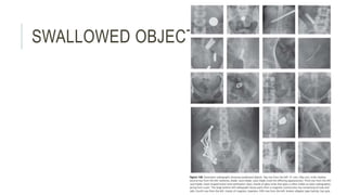 SWALLOWED OBJECTS
 