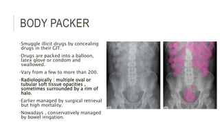 BODY PACKER
•Smuggle illicit drugs by concealing
drugs in their GIT.
•Drugs are packed into a balloon,
latex glove or condom and
swallowed.
•Vary from a few to more than 200.
•Radiologically : multiple oval or
tubular soft tissue opacities ,
sometimes surrounded by a rim of
halo.
•Earlier managed by surgical retrieval
but high mortality.
•Nowadays , conservatively managed
by bowel irrigation.
 