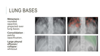 LUNG BASES
•Metastasis :
rounded
opacities
projected over
lung bases
•Consolidation :
patchy
opacification.
•Large pleural
effusion/
collapse :
whiteout
 