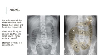 7) BOWEL
Normally most of the
bowel contains fluid/
faeces (light grey ) and
hence not visualized.
Colon most likely to
contain gas than the
small bowel , hence
easier to identify.
Stomach is visible if it
contains air .
 