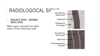 RADIOLOGOCAL SIGNS
1. RIGLER’S SIGN – DOUBLE
WALL SIGN
When gas is present on both
sides of the intestinal wall .
 