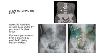 2) GAS OUTLINING THE
LIVER
Normally liver(light
grey) is surrounded by
peritoneal fat(dark
grey).
If pneumoperitoneum ,
liver is outlined by
gas(black) giving
better contrast.
 
