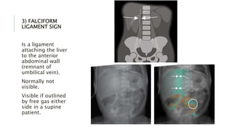 3) FALCIFORM
LIGAMENT SIGN
Is a ligament
attaching the liver
to the anterior
abdominal wall
(remnant of
umbilical vein).
Normally not
visible.
Visible if outlined
by free gas either
side in a supine
patient.
 