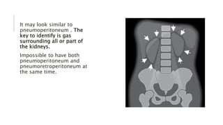 It may look similar to
pneumoperitoneum . The
key to identify is gas
surrounding all or part of
the kidneys.
Impossible to have both
pneumoperitoneum and
pneumoretroperitoneum at
the same time.
 