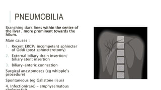 PNEUMOBILIA
Branching dark lines within the centre of
the liver , more prominent towards the
hilum.
Main causes :
1. Recent ERCP/ incompetent sphincter
of Oddi (post sphincterotomy)
2. External biliary drain insertion/
biliary stent insertion
3. Biliary-enteric connection
Surgical anastomoses (eg whipple’s
procedure)
Spontaneous (eg Gallstone ileus)
4. Infection(rare) – emphysematous
 