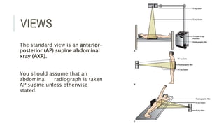 VIEWS
The standard view is an anterior-
posterior (AP) supine abdominal
xray (AXR).
You should assume that an
abdominal radiograph is taken
AP supine unless otherwise
stated.
 