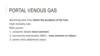 PORTAL VENOUS GAS
Branching dark lines within the periphery of the liver.
High mortality rate.
Main causes:
1. ischaemic bowel (most common)
2. necrotising enterocolitis (NEC) – most common in infants.
3. severe intra-abdominal sepsis
 
