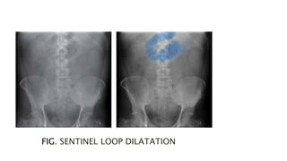 FIG. SENTINEL LOOP DILATATION
 